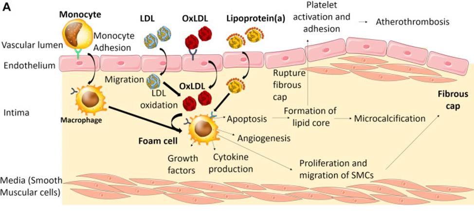 LDL