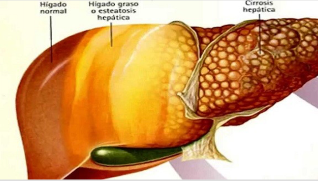 fatty liver