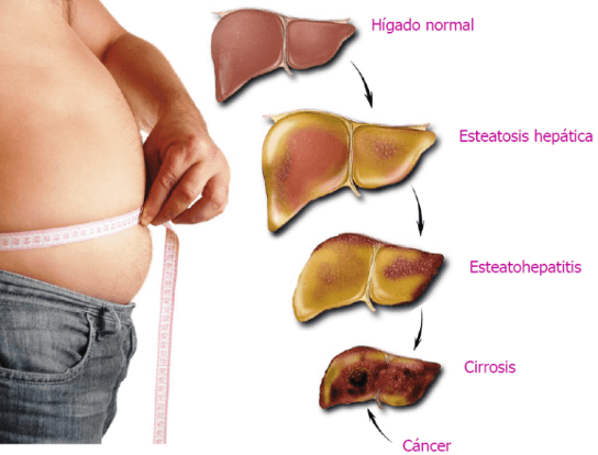 fatty liver