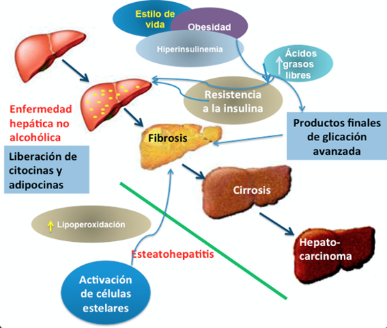 fatty liver