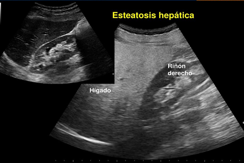 fatty liver