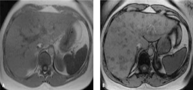 fatty liver