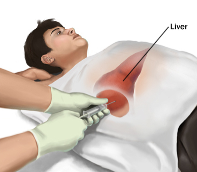 fatty liver