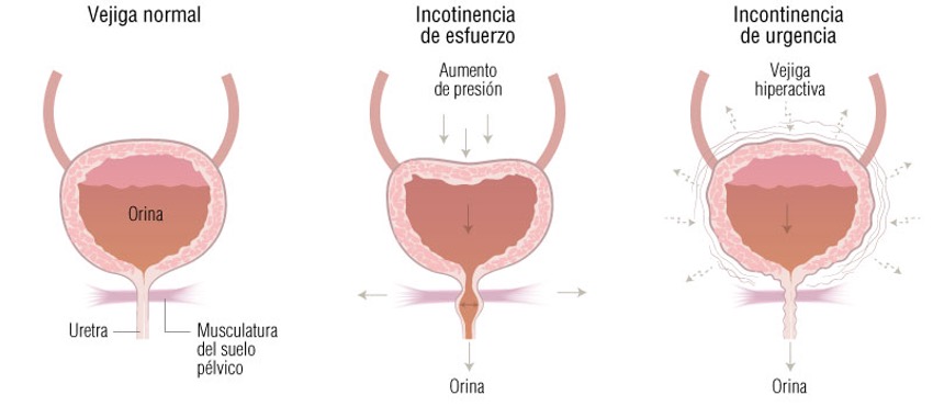 tipos de incontinencia urinaria