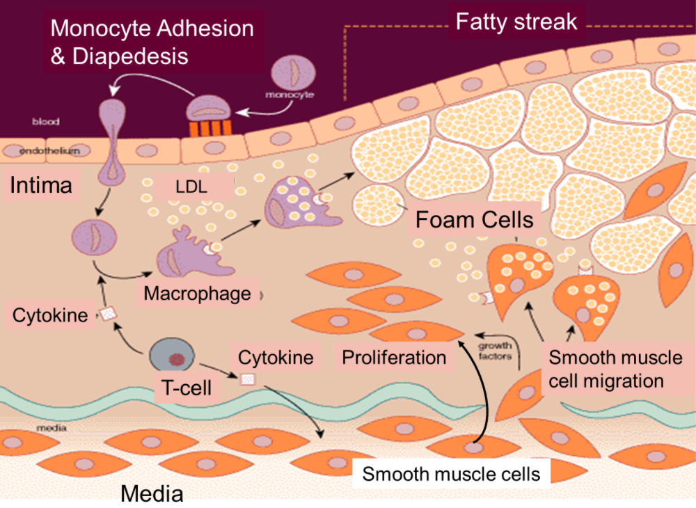 Ateroesclerosis