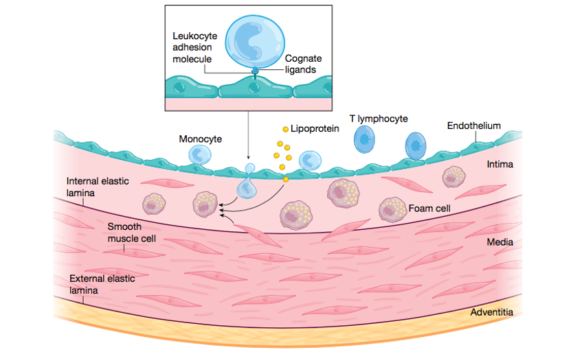 Ateroesclerosis